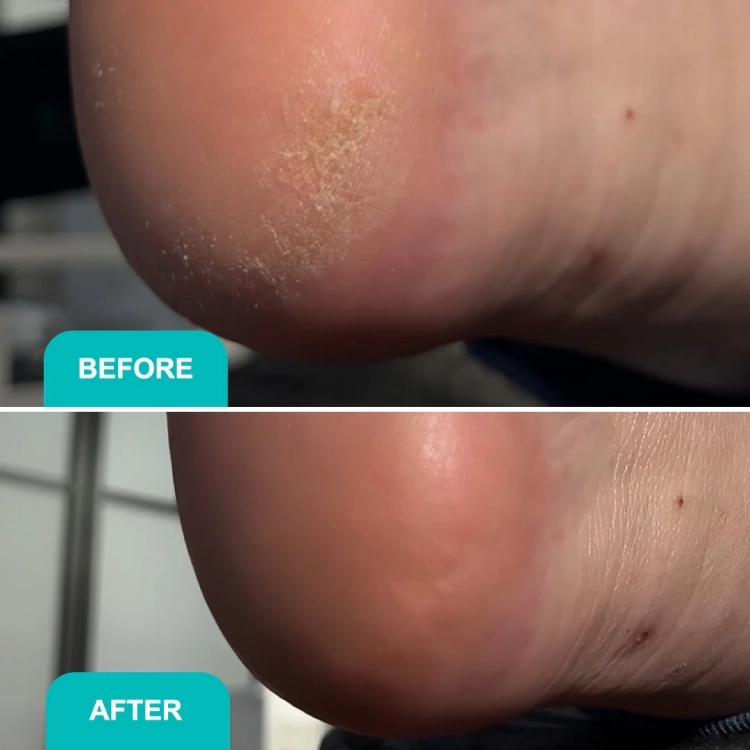 keratolityk, żel keratolityczny shelly, remover do modzeli, preparat do pedicure frezarkowego, usuwanie nagniotków, soft blade shelly 200 ml, profesjonalny keratolityk do stóp